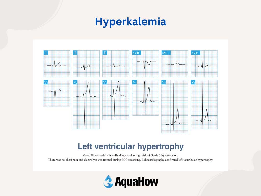 Hyperkalemia